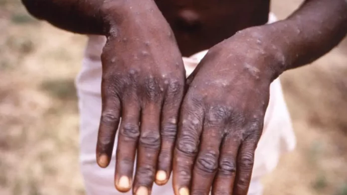 One dies as Nigeria records 41 cases of monkeypox