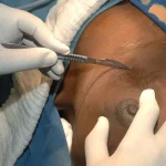 Africa Records Sharpest Rise in Breast Cancer Cases as Nigeria Sees 542% Surge Since 1990