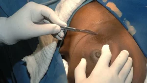 Africa Records Sharpest Rise in Breast Cancer Cases as Nigeria Sees 542% Surge Since 1990