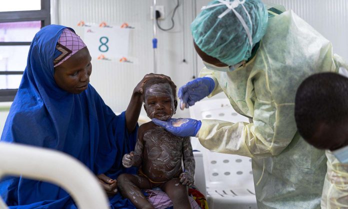 Suspected Measles Outbreak in Abuja Claims Lives of 10 Children