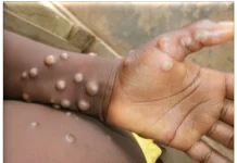 Understanding Monkeypox: Symptoms, Causes, and Prevention of Mpox