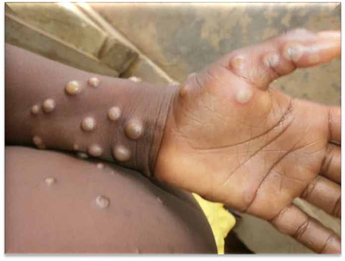 Understanding Monkeypox: Symptoms, Causes, and Prevention of Mpox