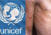 UNICEF seeks $59 million to tackle mpox in Burundi, DRC, four other African countries